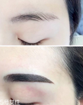 激光洗眉恢復(fù)期有疤痕怎么辦？激光洗眉毛之后正確護(hù)理方法