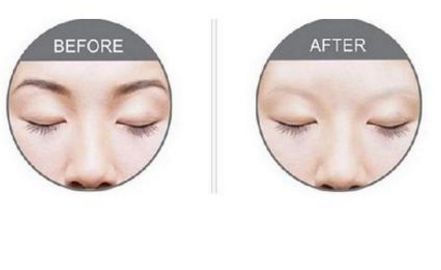 激光洗眉恢復(fù)期有疤痕怎么辦？激光洗眉毛之后正確護(hù)理方法