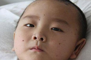 痣什么情況下會轉(zhuǎn)變?yōu)榱?？點痣不可取