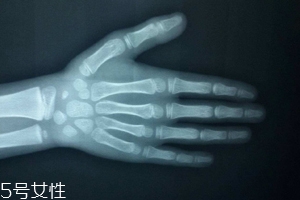 哪些人需要測骨齡？長太快警惕骨齡提前