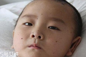 痣什么情況下會(huì)轉(zhuǎn)變?yōu)榱觯奎c(diǎn)痣不可取