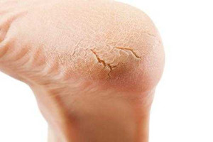 冬天裂腳怎么辦？5招緩解裂腳