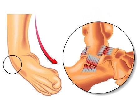 崴腳了怎么辦？緩解疼痛6大招
