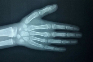 哪些人需要測(cè)骨齡？長(zhǎng)太快警惕骨齡提前