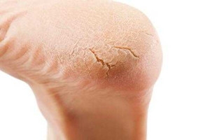 冬天裂腳怎么辦？5招緩解裂腳