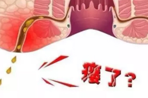肛瘺非手術(shù)治療才可以嗎？手術(shù)是治療的關(guān)鍵途徑