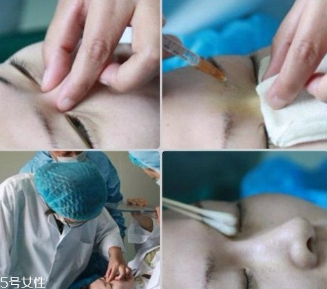 玻尿酸隆鼻維持時(shí)間受什么影響？玻尿酸不能過(guò)度注射