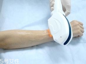 激光脫毛需要幾次？激光脫毛并不是終身有效的