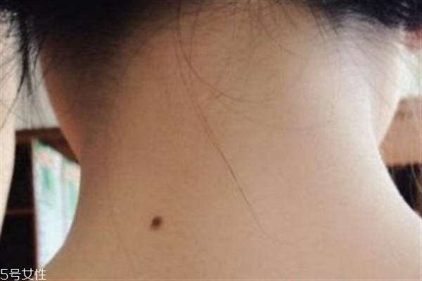 脖子后面有痣好嗎？激光冷凍祛痣易導(dǎo)致癌變