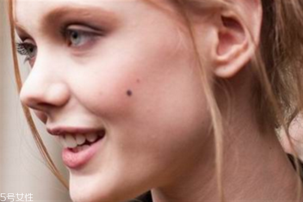 什么時(shí)候點(diǎn)痣最好？蘋(píng)果醋可以去痣