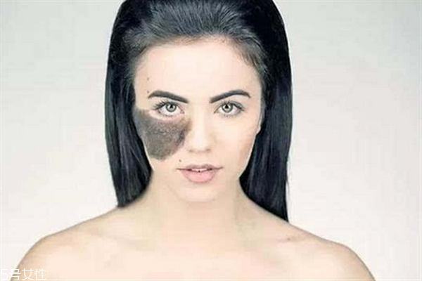 胎記長(zhǎng)在哪里有福氣？胎記的本質(zhì)是色素沉著