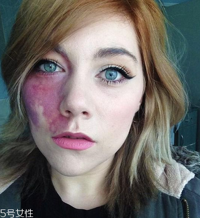 胎記長(zhǎng)在哪里有福氣？胎記的本質(zhì)是色素沉著