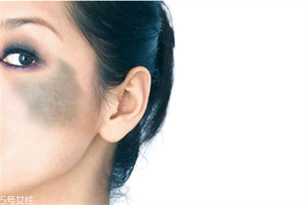 胎記怎么去除？胎記有遺傳的可能