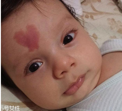 去胎記要多少錢？胎記去除后要做好護(hù)理