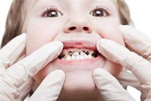 寶寶齲齒常有哪些問題？齲齒問題需注意