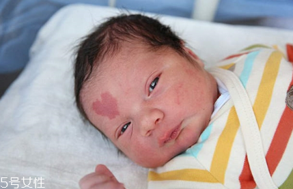 胎記長(zhǎng)在哪里有福氣？胎記的本質(zhì)是色素沉著