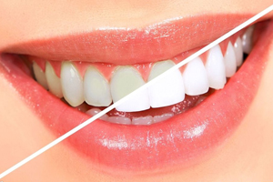 牙齒發(fā)黃是天生的嗎？只是你刷牙偷懶了