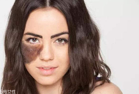 胎記長(zhǎng)在哪里有福氣？胎記的本質(zhì)是色素沉著