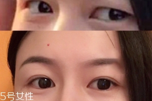 內(nèi)雙怎么進(jìn)化成雙眼皮？全是雙眼皮貼的功勞