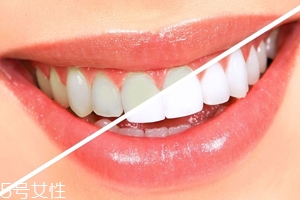 牙齒發(fā)黃是天生的嗎？只是你刷牙偷懶了