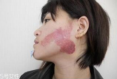 胎記怎么去除？胎記有遺傳的可能