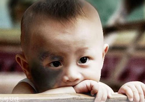 胎記怎么去除？胎記有遺傳的可能