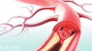 血管堵塞怎么自查？腿腳告訴你答案