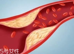 血管堵塞怎么自查？腿腳告訴你答案