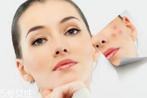 痘印多久能自行消失？多數(shù)人一年內(nèi)消失