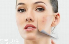 痘印多久能自行消失？多數(shù)人一年內(nèi)消失