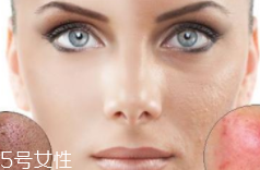 痘印多久能自行消失？多數(shù)人一年內(nèi)消失