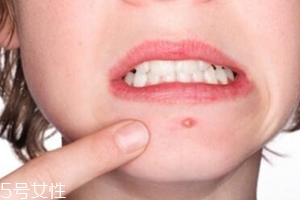 肌膚需要排毒嗎？長痘并不代表排毒