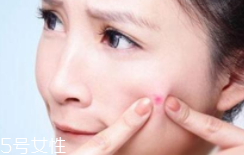 肌膚需要排毒嗎？長痘并不代表排毒