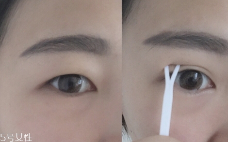 雙眼皮貼一般多少錢？