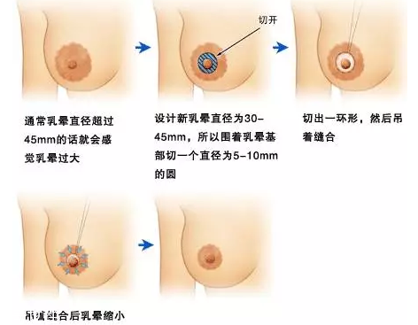 乳暈縮小術(shù)怎么做？乳暈縮小術(shù)知識(shí)全解