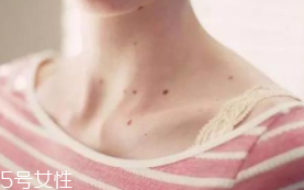 色素痣是腫瘤嗎？良性腫瘤不必?fù)?dān)心