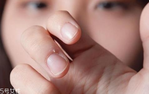 手指起倒刺是什么原因 肌膚太干燥引起 手指起倒刺是什么原因 肌膚太干燥引起