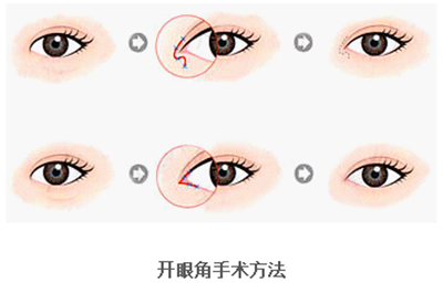 開(kāi)眼角疤痕多久消失？開(kāi)眼角的適宜人群