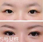 開(kāi)眼角疤痕多久消失？開(kāi)眼角的適宜人群
