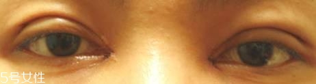 怎么縮短開眼角疤痕消失時(shí)間？雙眼皮開眼角恢復(fù)過程