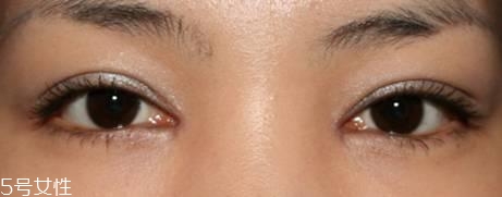 怎么縮短開眼角疤痕消失時(shí)間？雙眼皮開眼角恢復(fù)過程