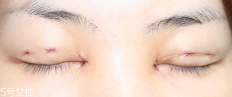 怎么縮短開眼角疤痕消失時(shí)間？雙眼皮開眼角恢復(fù)過程
