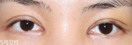怎么縮短開眼角疤痕消失時(shí)間？雙眼皮開眼角恢復(fù)過程