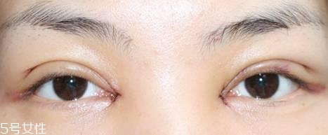 怎么縮短開眼角疤痕消失時(shí)間？雙眼皮開眼角恢復(fù)過程