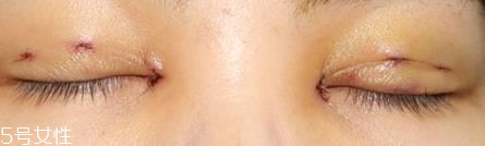 怎么縮短開眼角疤痕消失時(shí)間？雙眼皮開眼角恢復(fù)過程