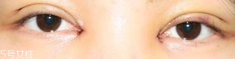 怎么縮短開眼角疤痕消失時(shí)間？雙眼皮開眼角恢復(fù)過程