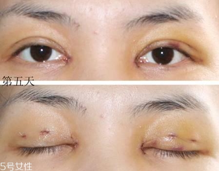 怎么縮短開眼角疤痕消失時(shí)間？雙眼皮開眼角恢復(fù)過程