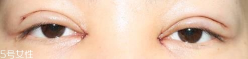 怎么縮短開眼角疤痕消失時(shí)間？雙眼皮開眼角恢復(fù)過程