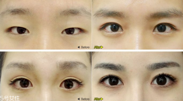 切開雙眼皮效果好嗎？韓式雙眼皮和歐式雙眼皮區(qū)別