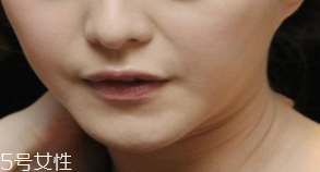 頸紋是怎么產(chǎn)生的？比面部肌膚更加脆弱